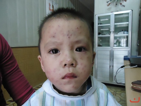 Bệnh nhân bệnh Thủy đậu