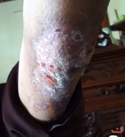 Bệnh zo na thần kinh và di chứng zo na thần kinh_2