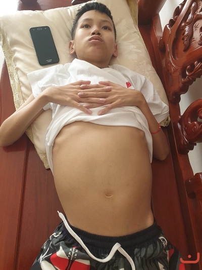 Bệnh sơ gan cổ trướng 7 năm