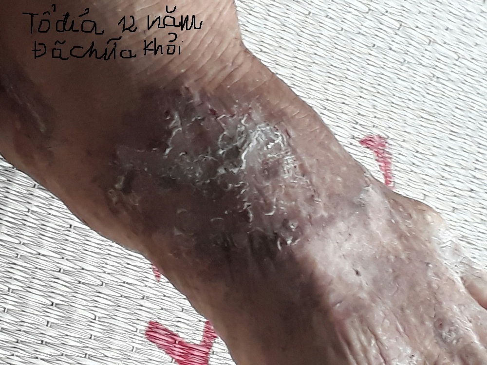 Tổ đỉa nghệ an chữa khỏi