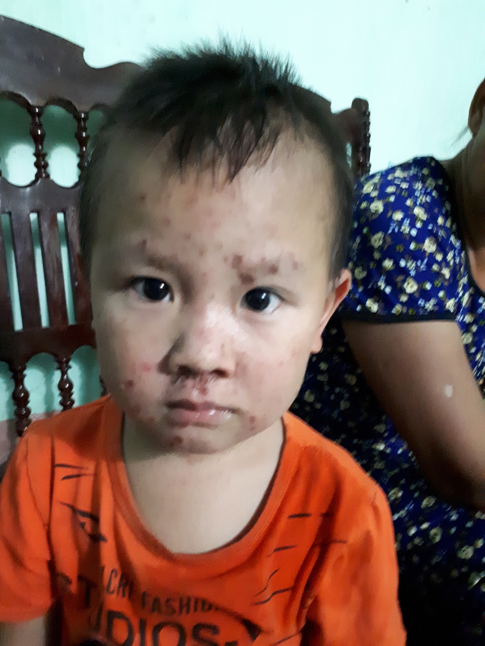 benh nhan viem da o loet thuoc nam lam hai thu 