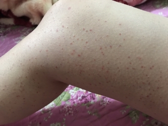 Bệnh nhân Nữ 40 tuổi ở huyện Văn Quan - tỉnh Lạng Sơn, bị xuất huyết ngoài da chữa thuốc tây y nhiều tháng không khỏi mà còn bệnh càng ngày càng nặng hơn chị đến phòng khám dùng thuốc nam trong một tháng bệnh đã khỏi ai bị bệnh như vậy tôi đảm bảo chữa khỏi ( Chữa bệnh bằng thuốc nam an toàn khỏi nhanh chi phí thấp khỏi nhanh)