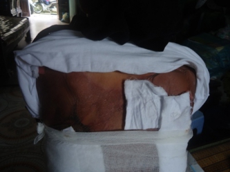 Bệnh nhân bệnh Pemphigus Bà Triệu Thị So