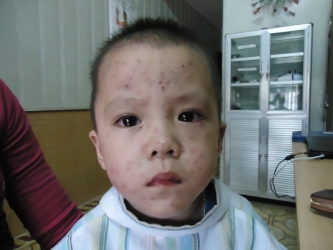 Bệnh nhân bệnh Thủy đậu