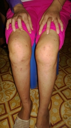 Bệnh nhân Viêm đa khớp