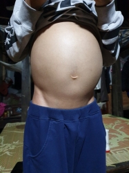 Bệnh sơ gan cổ trướng 7 năm