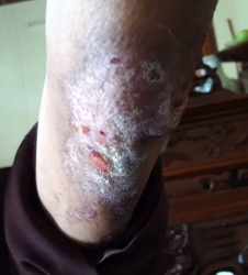 Bệnh zo na thần kinh và di chứng zo na thần kinh_2
