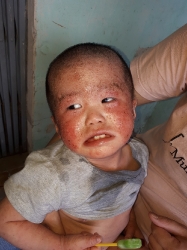 Bé bị viêm da lở loét toàn thân