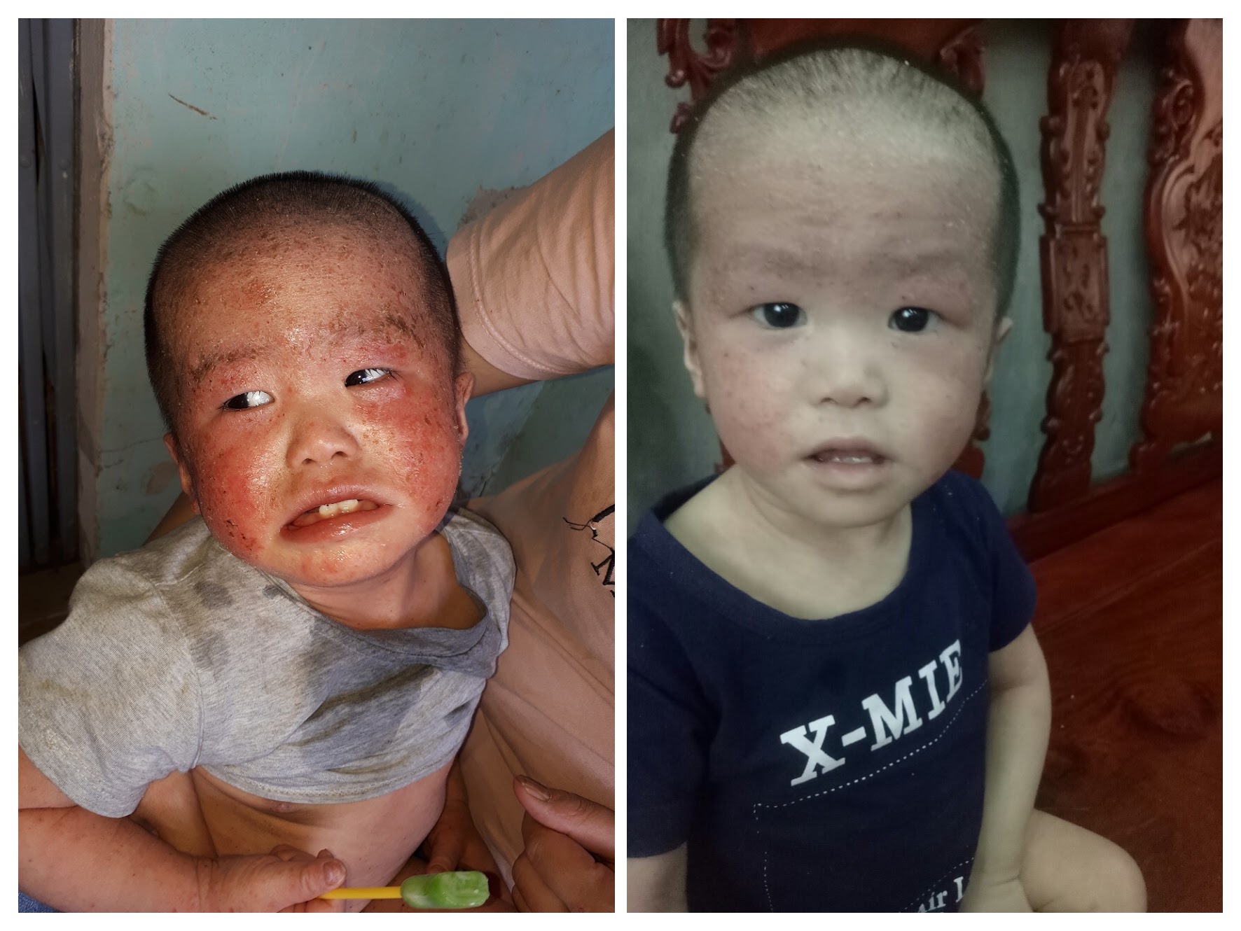 nguoi benh chua kho viem da lo loet 2 COLLAGE
