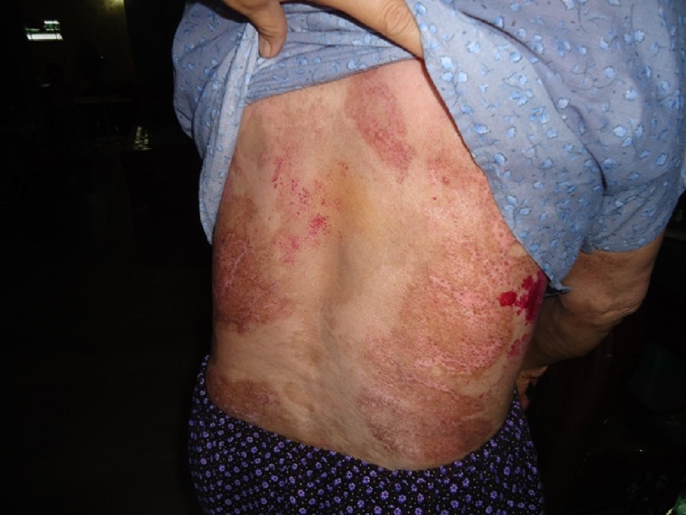 Bệnh nhận nhiễm Pemphigus năm 5 chữa khỏi