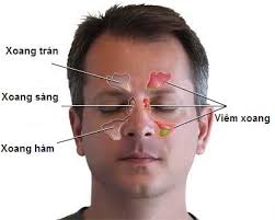 benh viem xoang