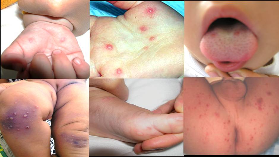 Chữa khỏi bệnh tay chân miệng bằng đông y